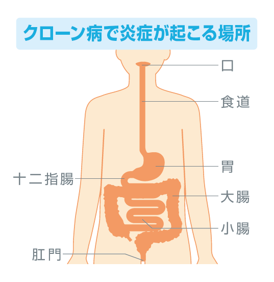 クローン病で炎症が起こる場所