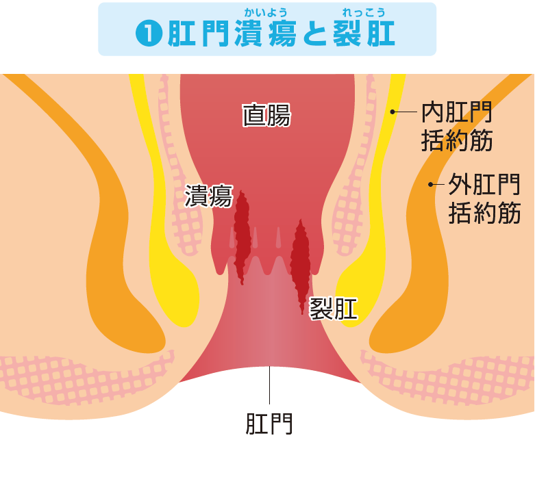 肛門潰瘍と裂肛