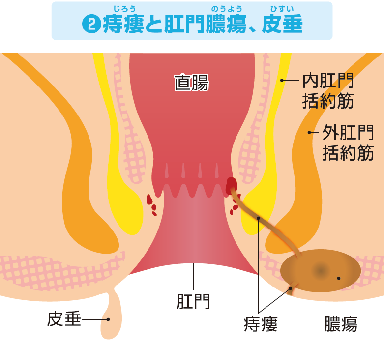 痔瘻と肛門膿瘍、皮垂
