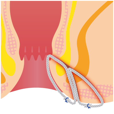 シートンドレナージ